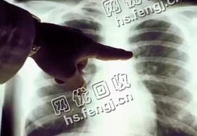 PET类X光片胸片回收