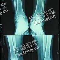 PET类X光片骨片回收